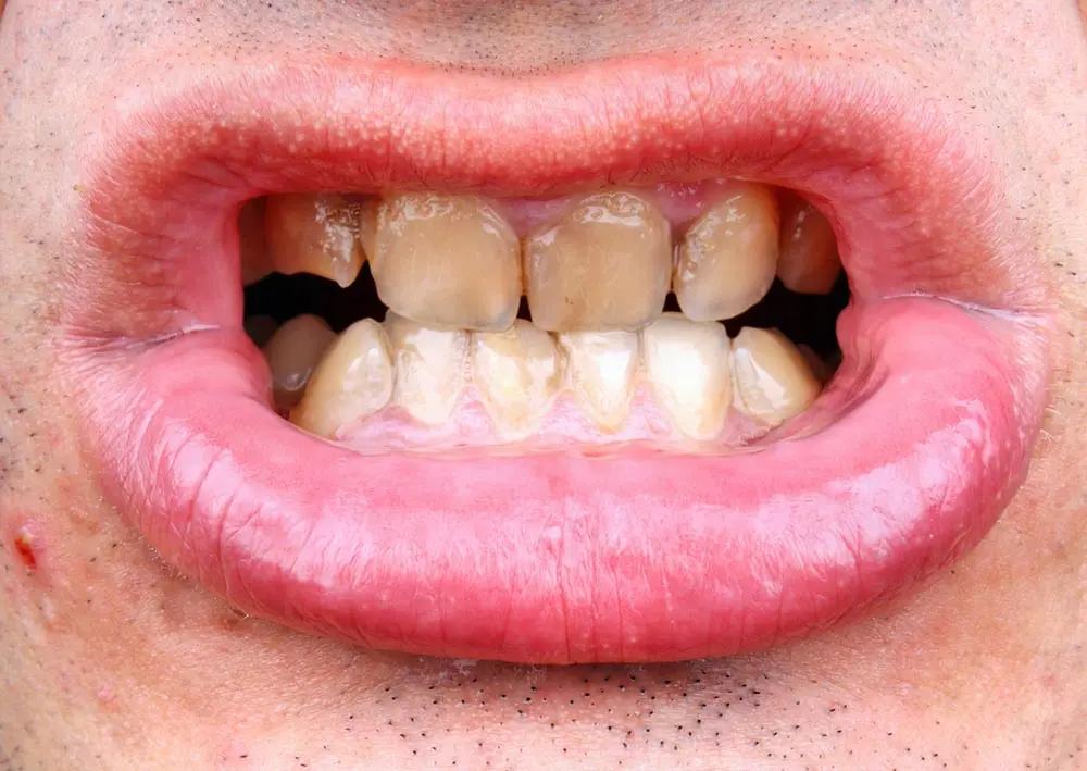dientes de acrilico manchados limpieza posible - Cómo quitar las manchas de nicotina de las prótesis dentales