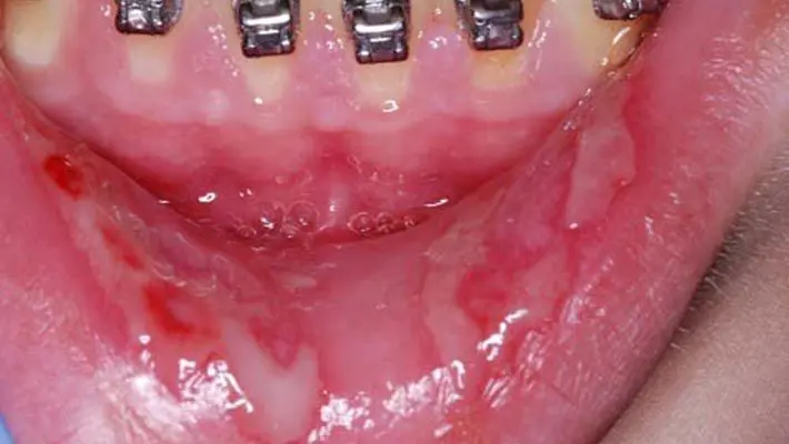alegias bucales por acrilico termocurable - Cómo saber si soy alergica a la resina dental