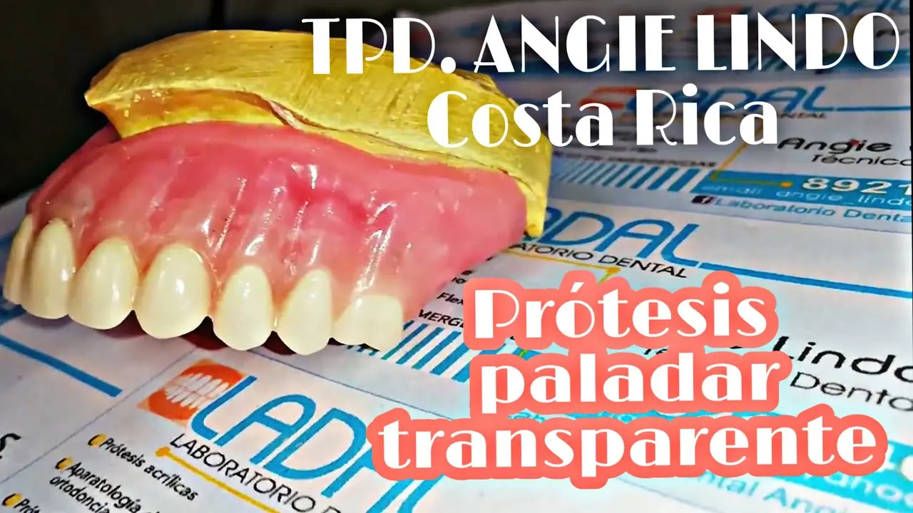 como.hacer una protesis completa de acrilico con paladar - Cómo son las prótesis dentales completas