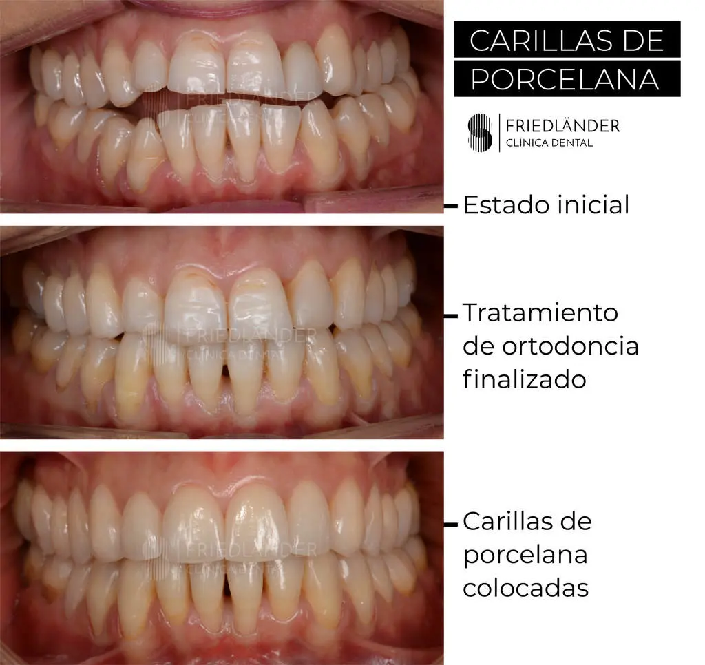 que es mejor el acrilico o el composite - Cuál es el mejor material para rellenos dentales