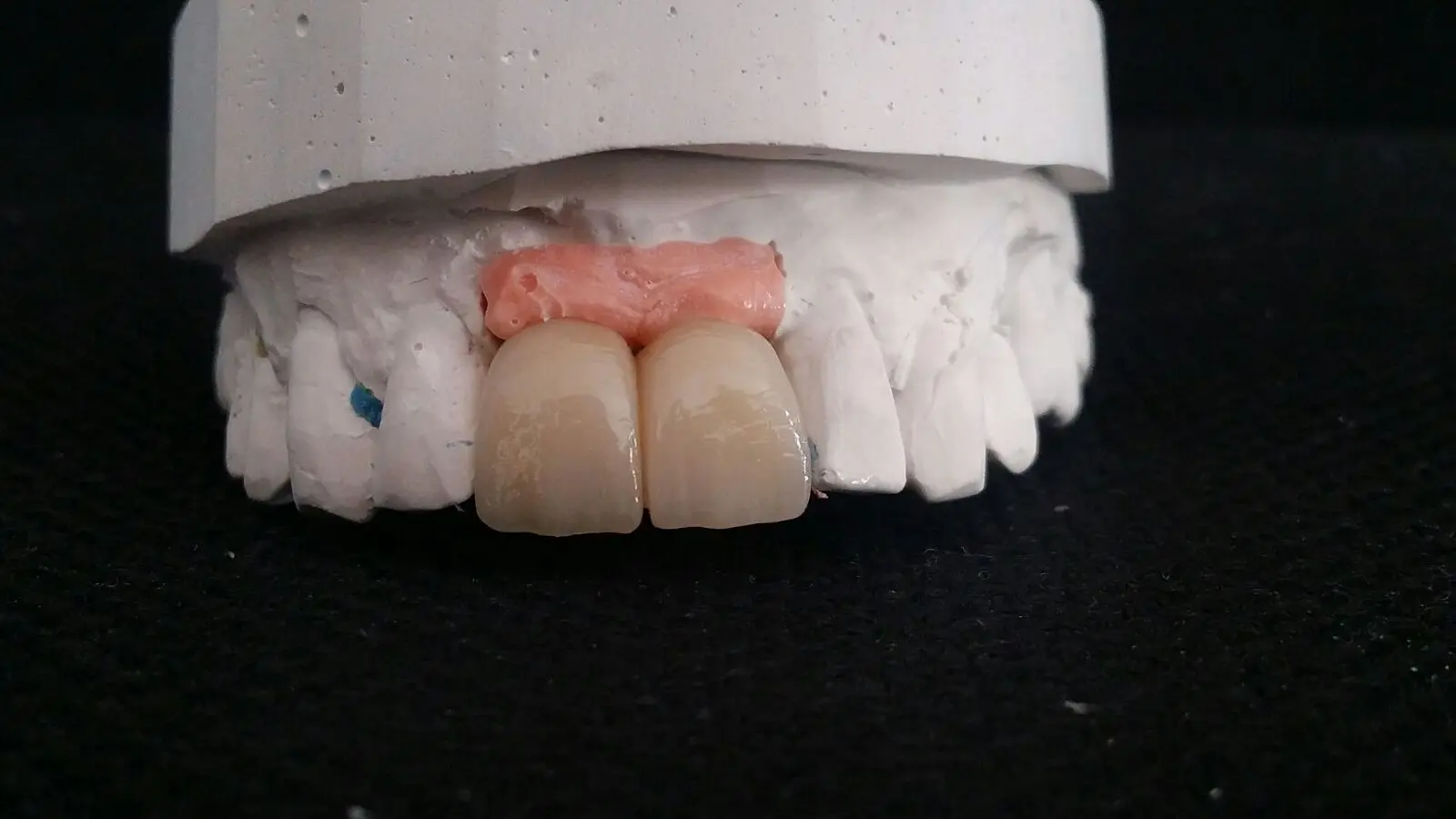 provisionales de acrilico confección en boca - Cuáles son los cementos provisionales en odontología