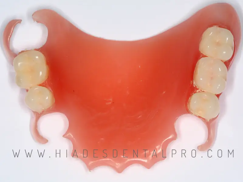 implantes dentales componentes sobre parcial de acrilico - Qué elementos componen una prótesis parcial fija