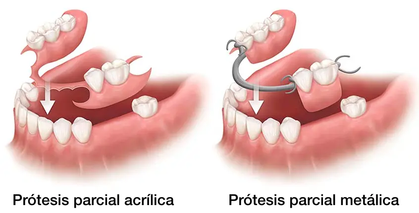 agregado de dientes y retenedores en protesis de acrilico - Qué es la retencion en prótesis removible