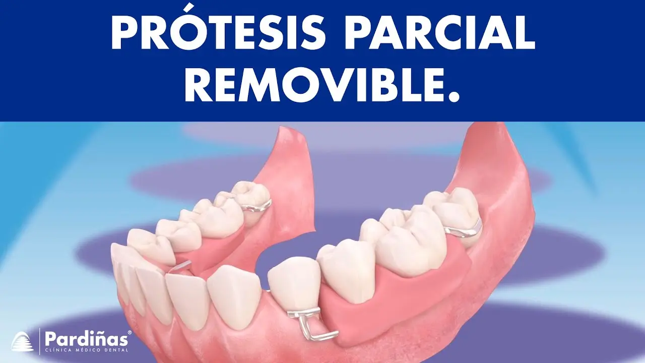 implantes dentales componentes sobre parcial de acrilico - Qué es un implante parcial