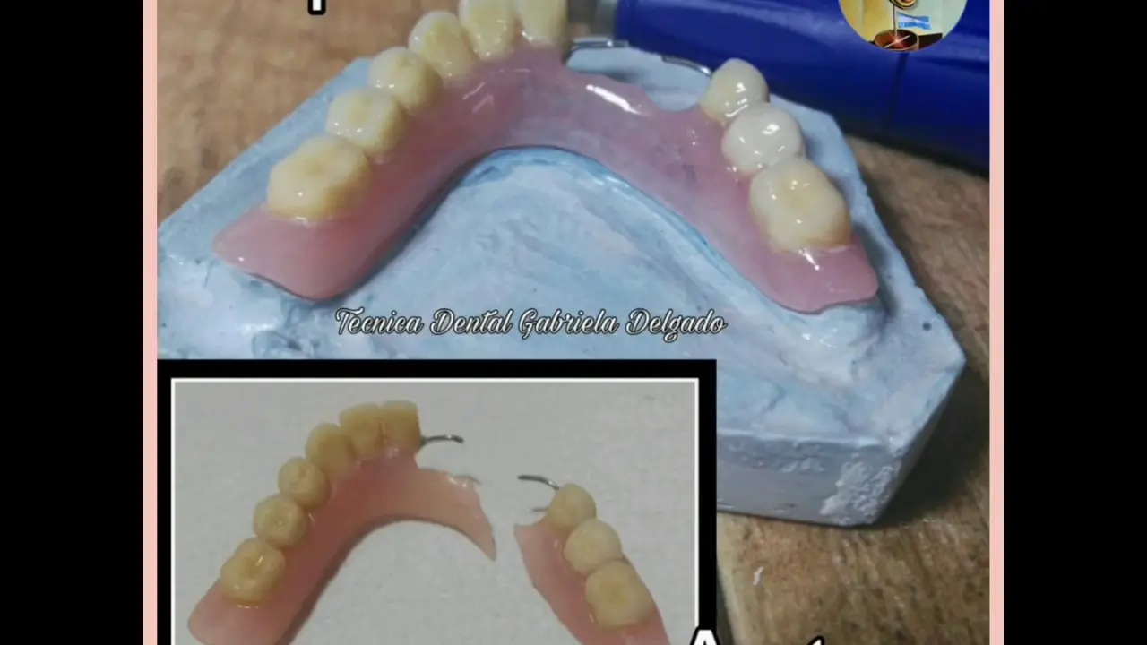 reparar protesis dental acrilico - Qué hacer si se rompe una prótesis dental