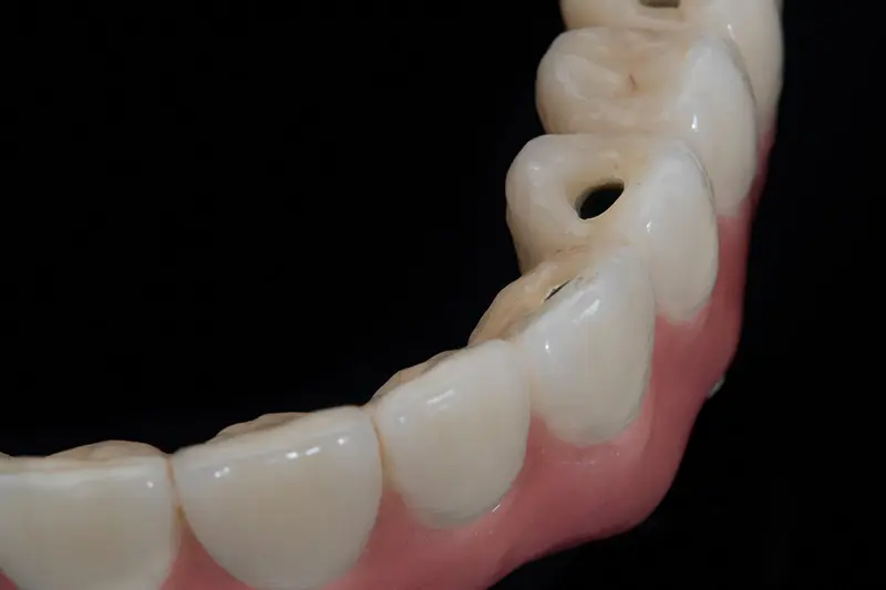 ¿Qué es el déficit metal acrílico? - Qué patologías son más comunes en pacientes portadores de prótesis déficit metal acrilico - Qué patologías son más comunes en pacientes portadores de prótesis