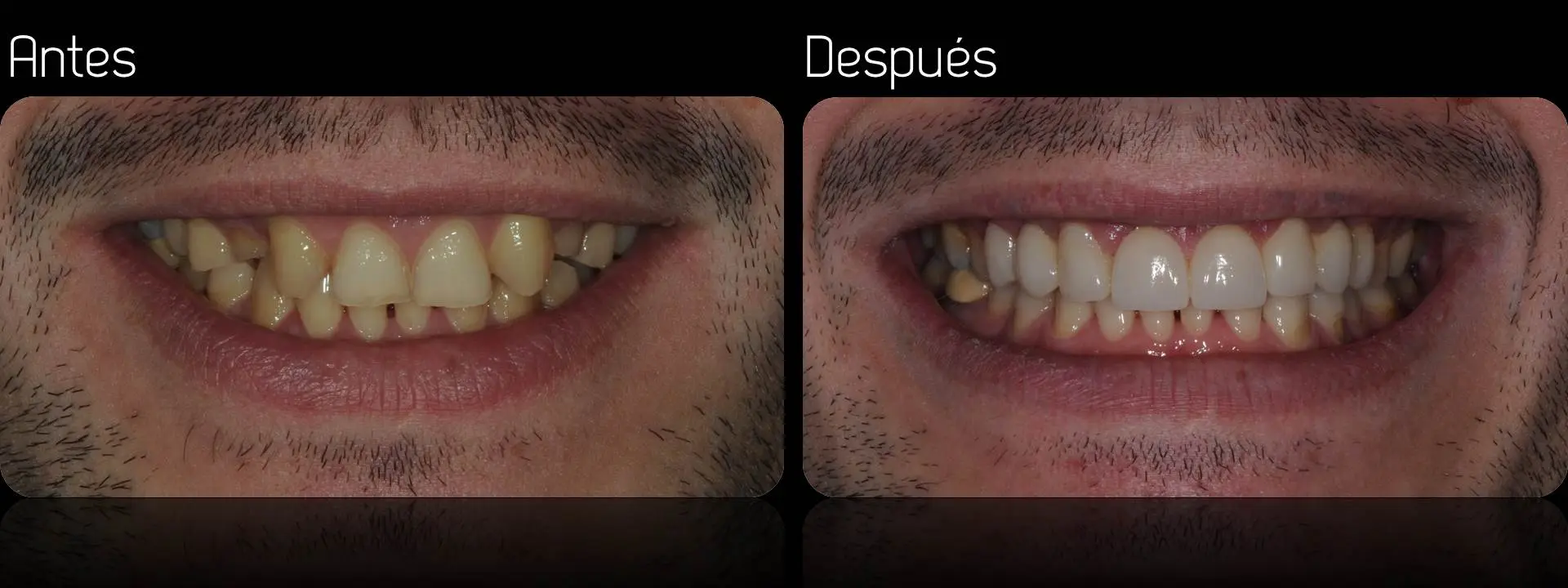 que es mejor dientes de porcelana o acrilico - Qué tipo de dentadura postiza es mejor